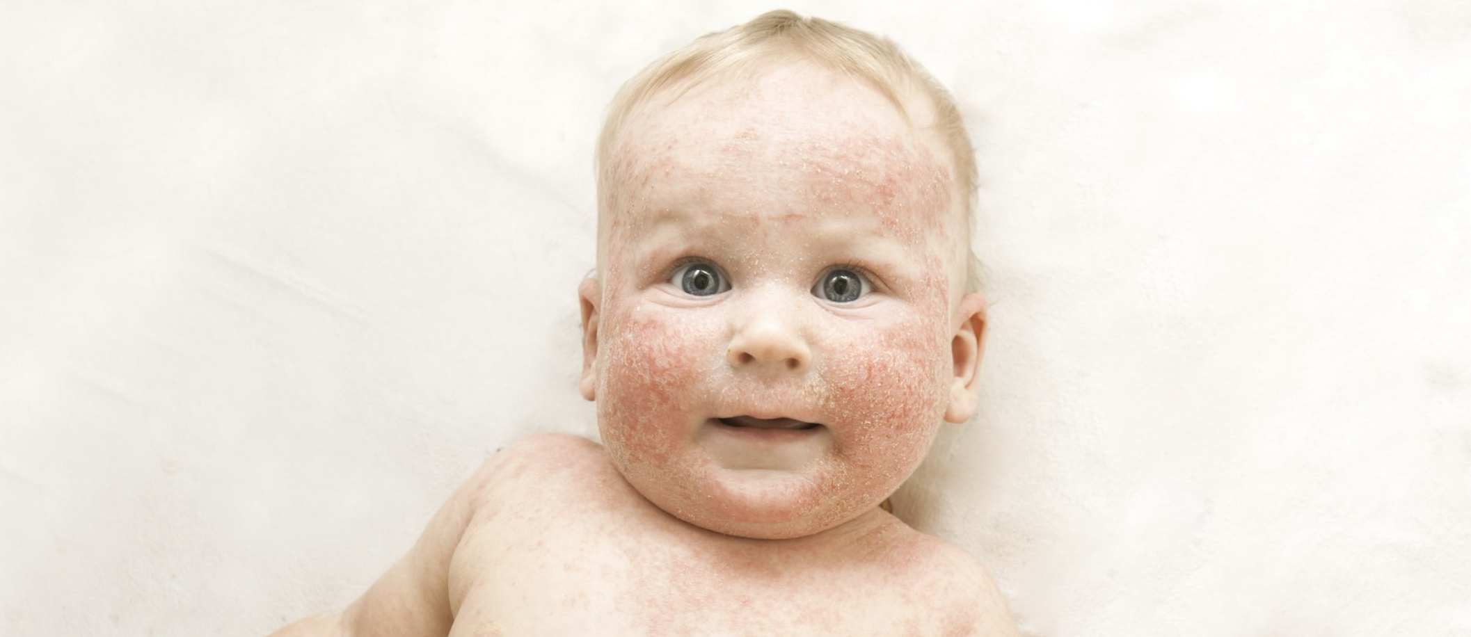 Colic, Reflux & Infant Allergies — Level 3